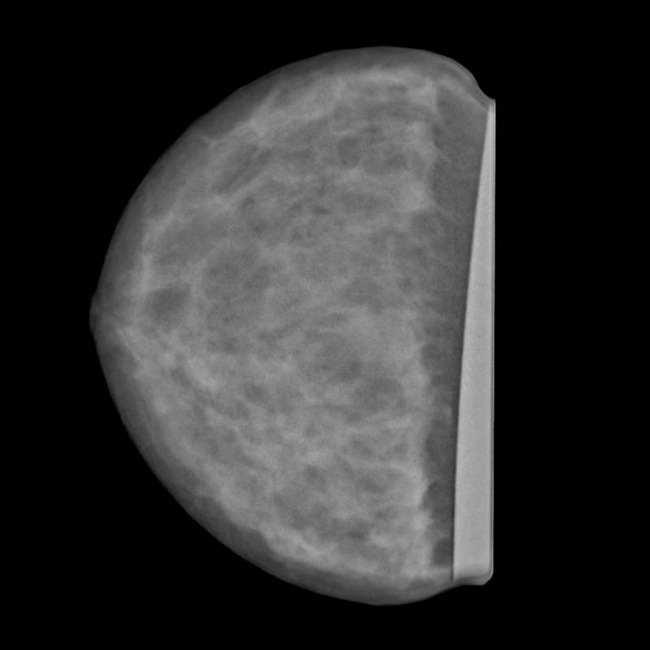 Breast Phantom for Mammography and Breast Tomosynthesis