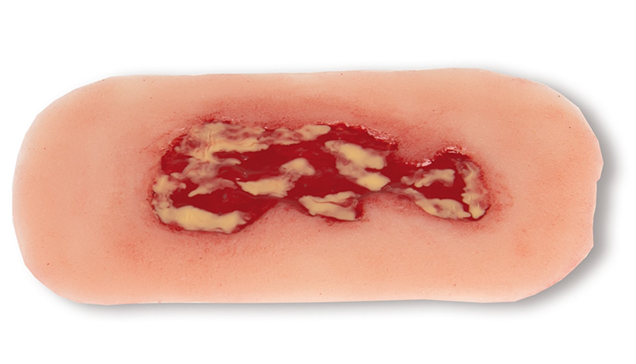 Wound Moulage Venous Leg Ulcer, Small, Exudation Phase