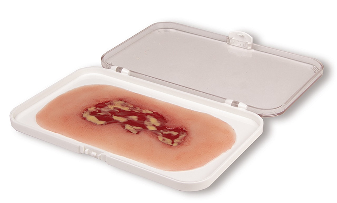 Wound Moulage Venous Leg Ulcer, Small, Exudation Phase