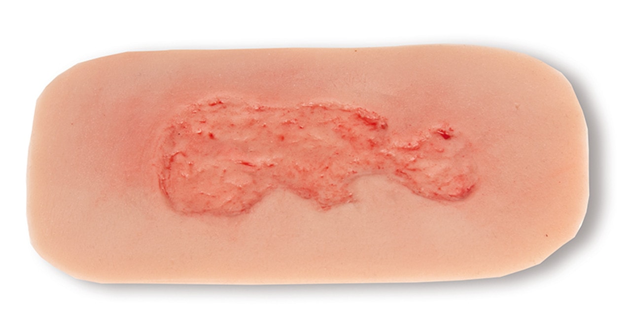 Wound Moulage Venous Leg Ulcer, Small, Epithelisation Phase
