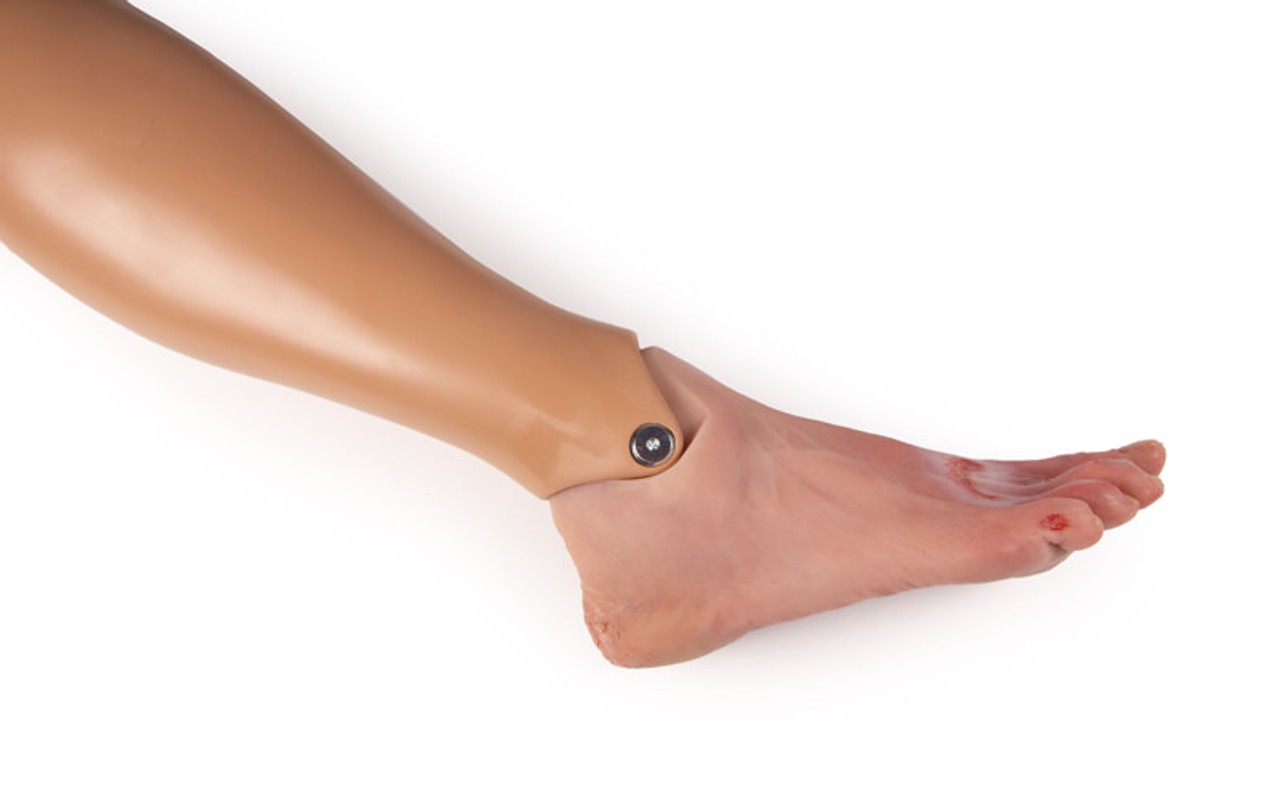 Wound Foot with Diabetic Foot Syndrome, Severe Stage