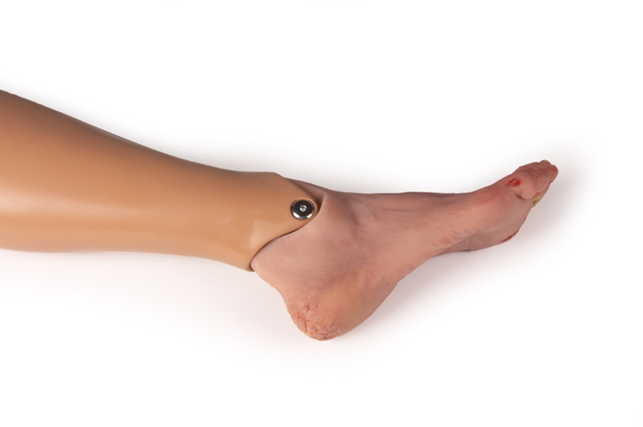 Wound Foot with Diabetic Foot Syndrome, Severe Stage