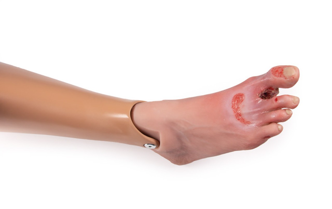 Wound Foot with Diabetic Foot Syndrome, Severe Stage