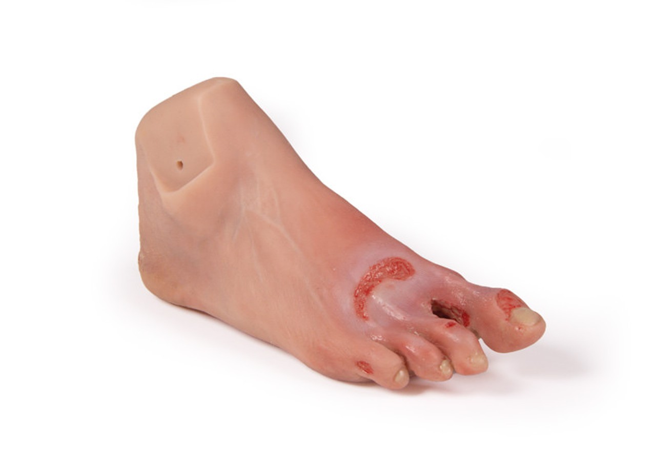 Wound Foot with Diabetic Foot Syndrome, Severe Stage