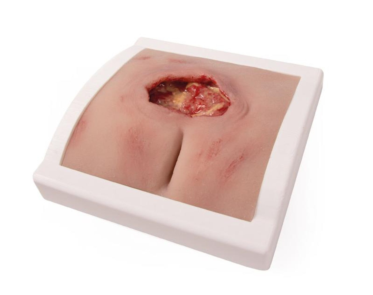 Wound Moulage Sacral Decubitus, Cleaned Including Stand