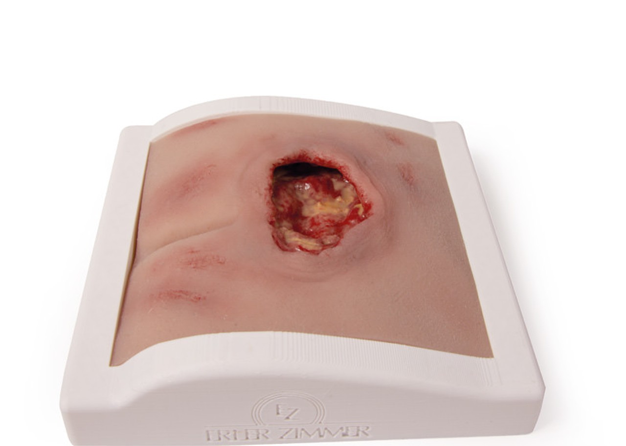 Wound Moulage Sacral Decubitus, Cleaned Including Stand