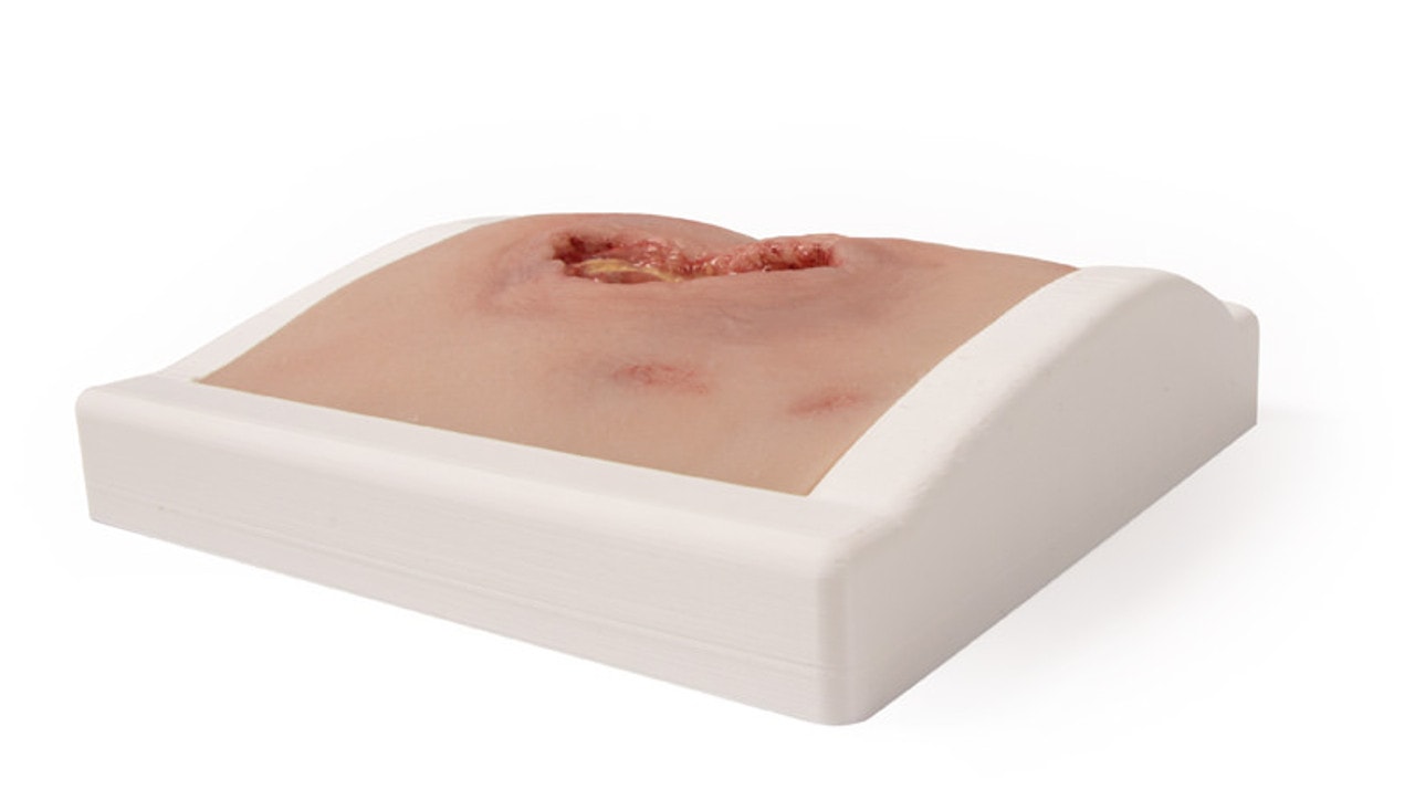 Wound Moulage Sacral Decubitus, Cleaned Including Stand