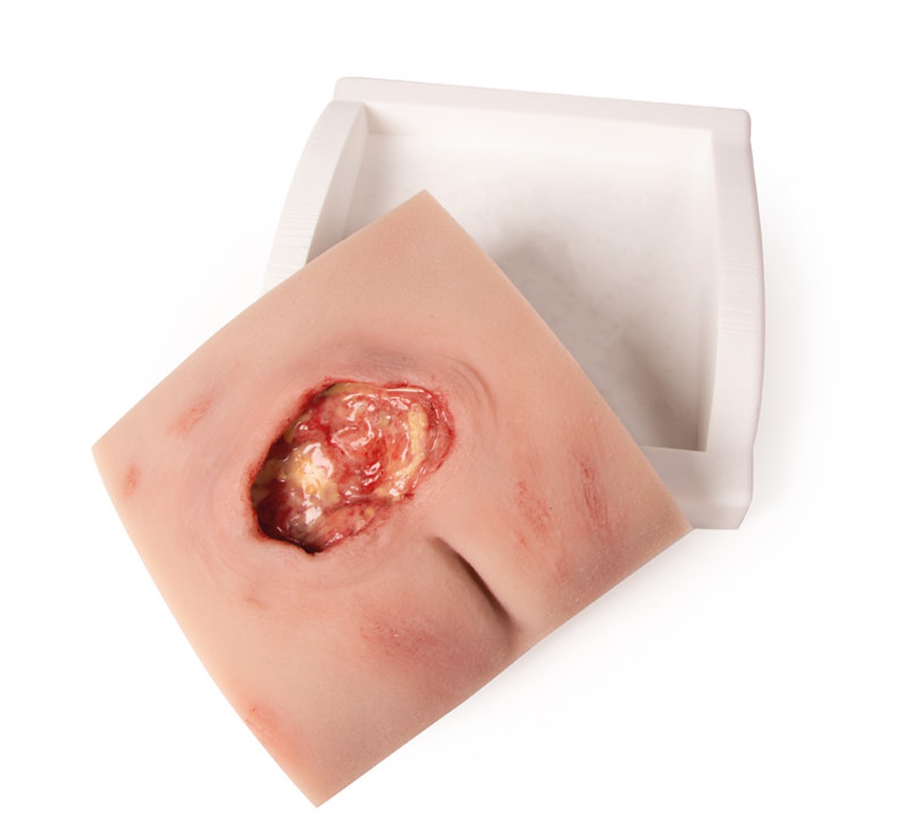 Wound Moulage Sacral Decubitus, Cleaned Including Stand