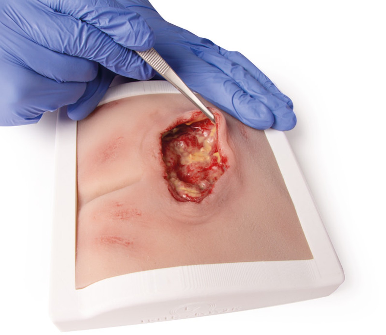 Wound Moulage Sacral Decubitus, Cleaned Including Stand