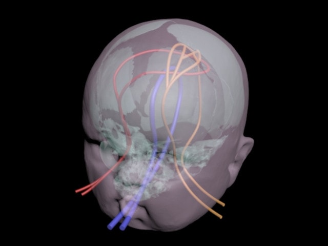 Dynamic Newborn Baby Head Phantom Model - Design
