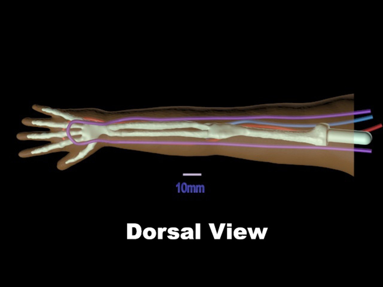 Newborn Baby Arm Phantom Model - Design
