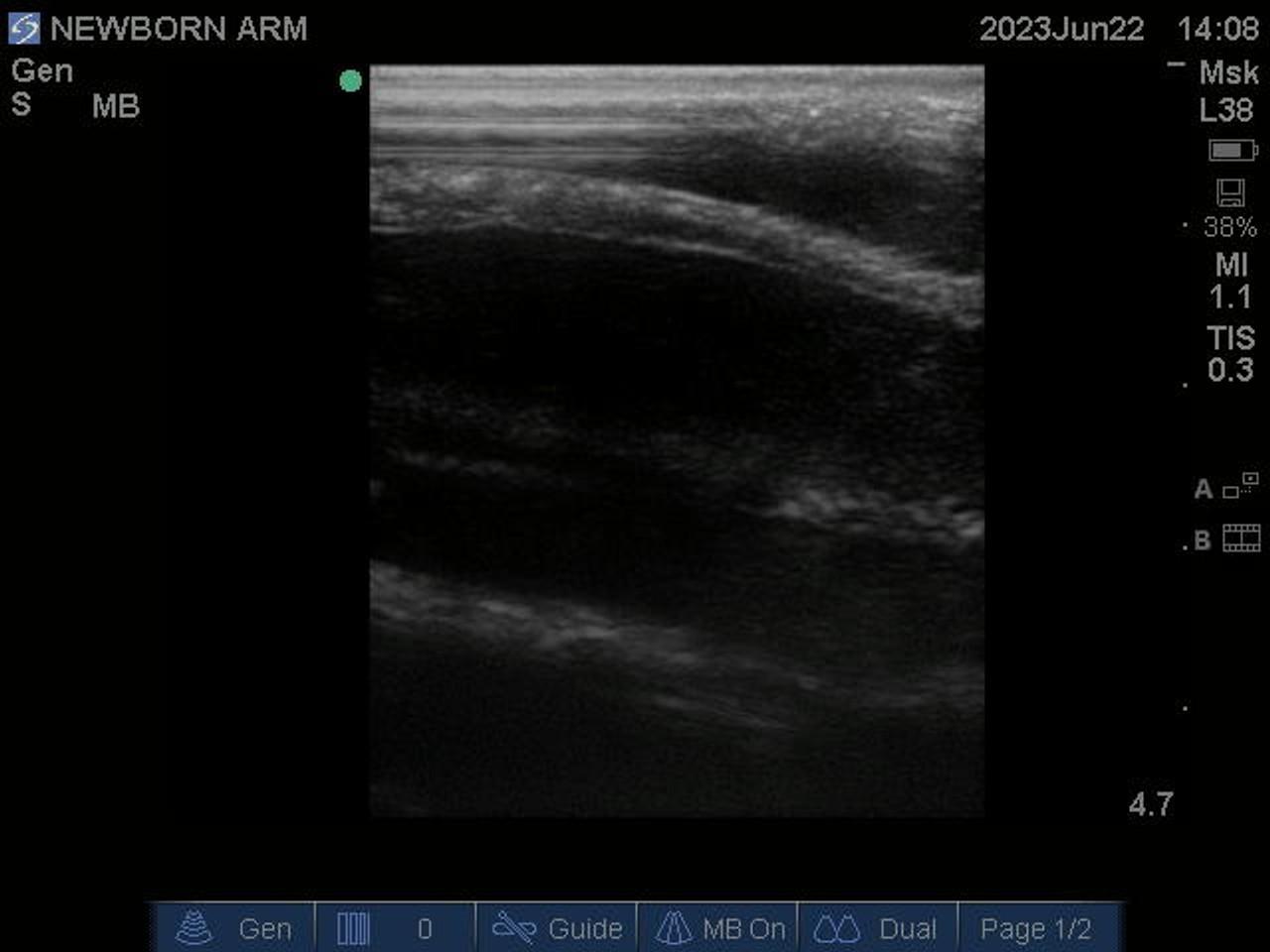 Newborn Baby Arm Phantom Model - Ultrasound scans