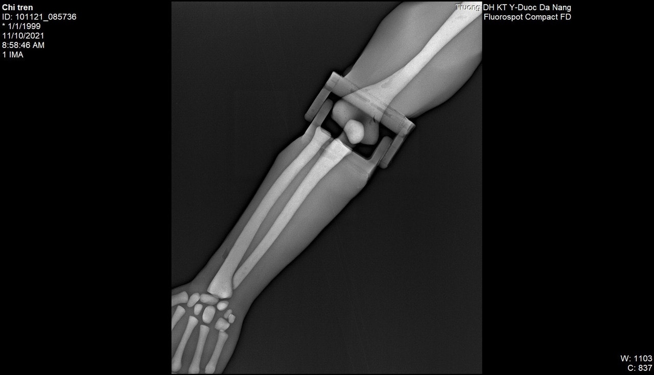 Adult Arm X-Ray Phantom Model - X-Ray scans
