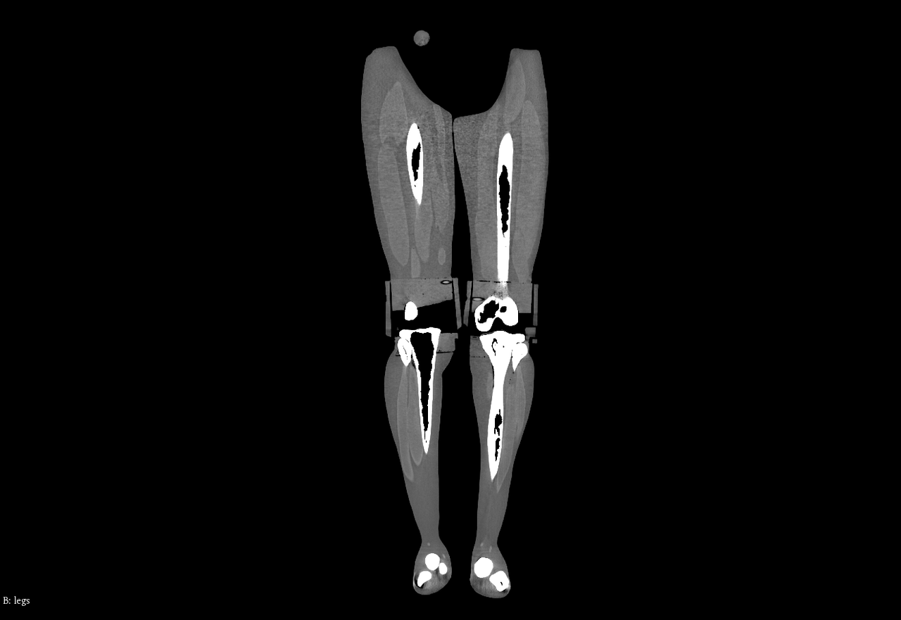 Adult Male Full Body X-Ray/CT and MRI Phantom Model - CT scans