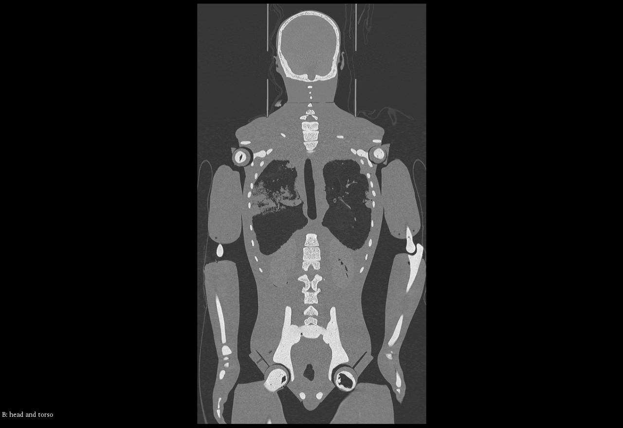 Adult Male Full Body X-Ray/CT and MRI Phantom Model - CT scans
