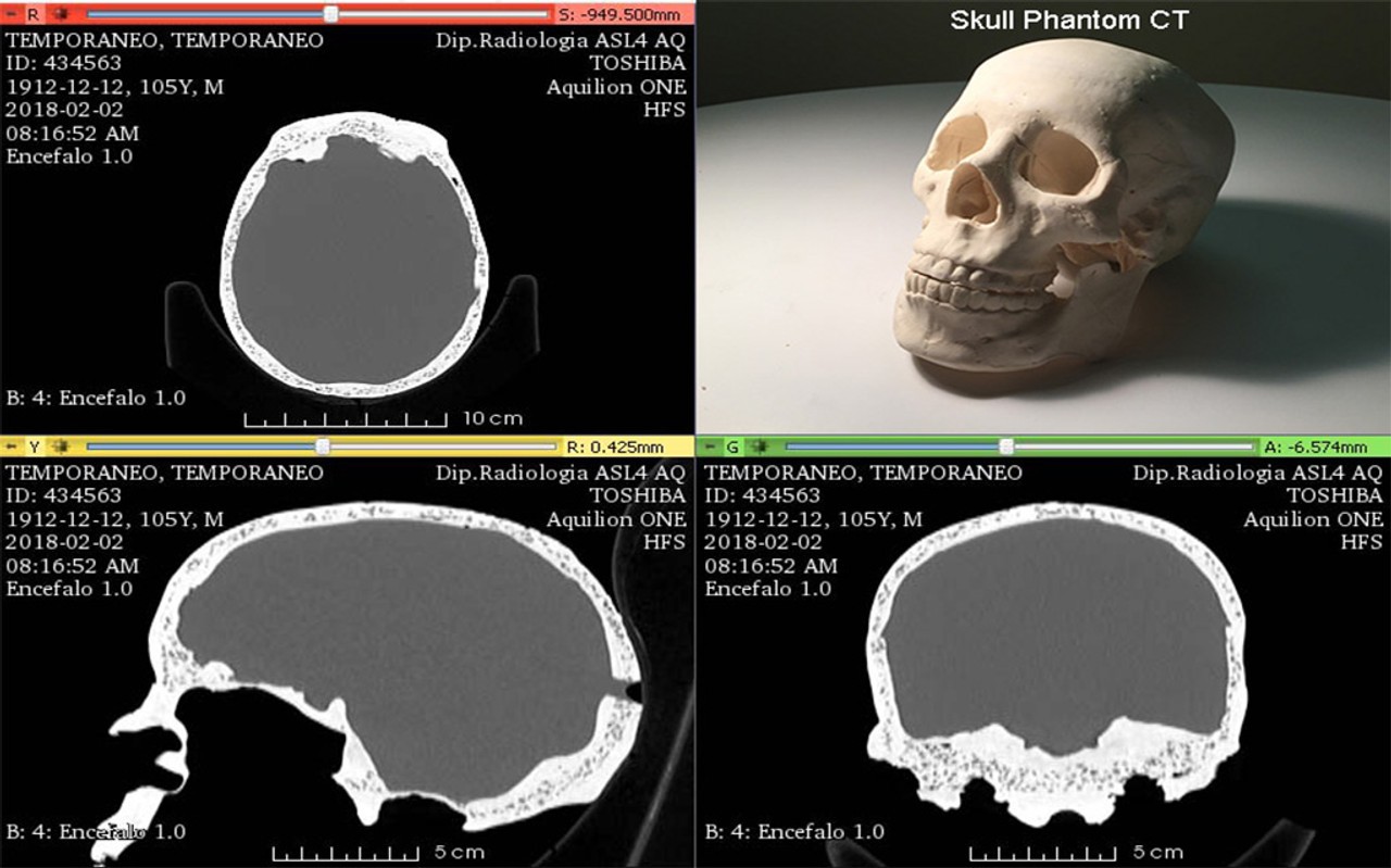Adult Male Skull Phantom
