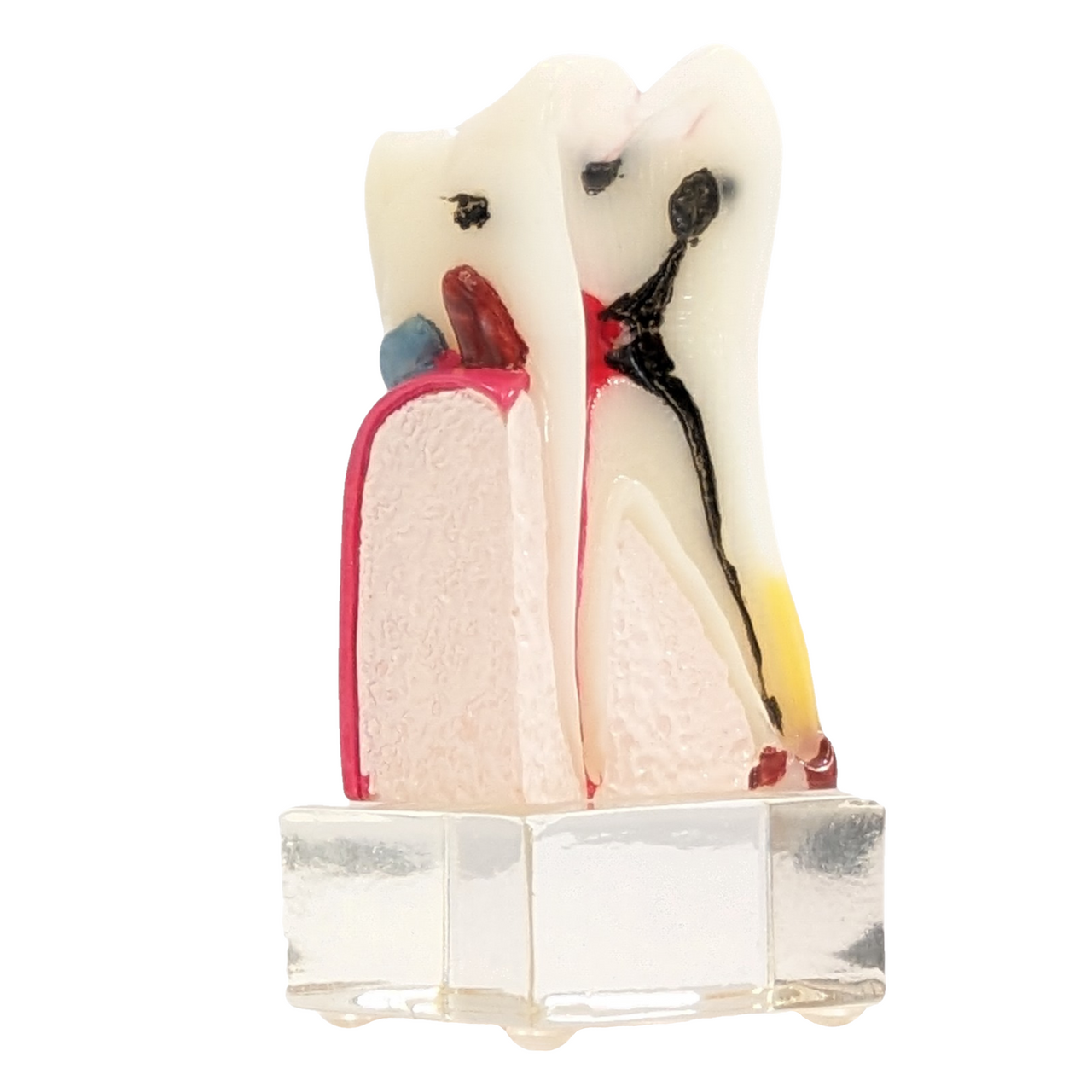 Axis Scientific Dental Model with Tooth Decay Scale, Enlarged 4 Times Life Size