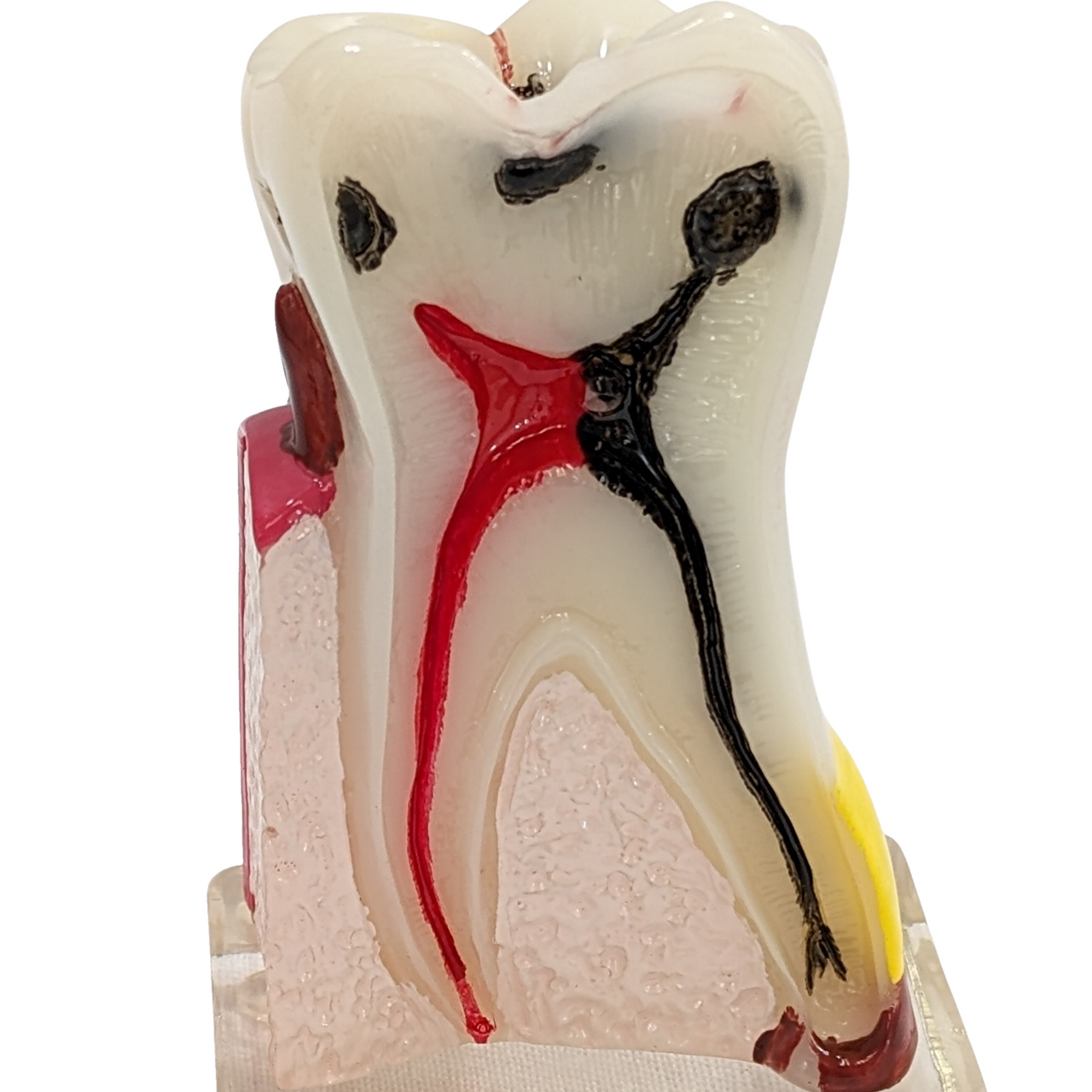Axis Scientific Dental Model with Tooth Decay Scale, Enlarged 4 Times Life Size