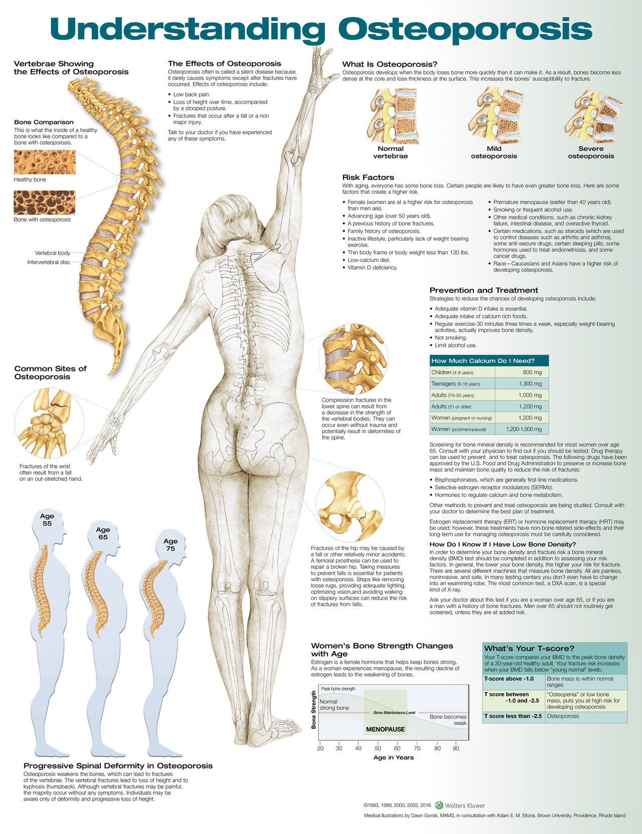 Understanding Osteoporosis Anatomical Chart - Laminated