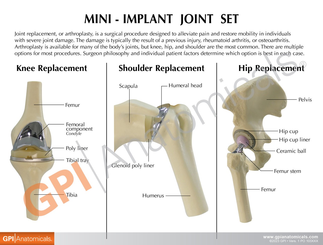 Mini Implant Joint Anatomy Model Set Front of Key Card