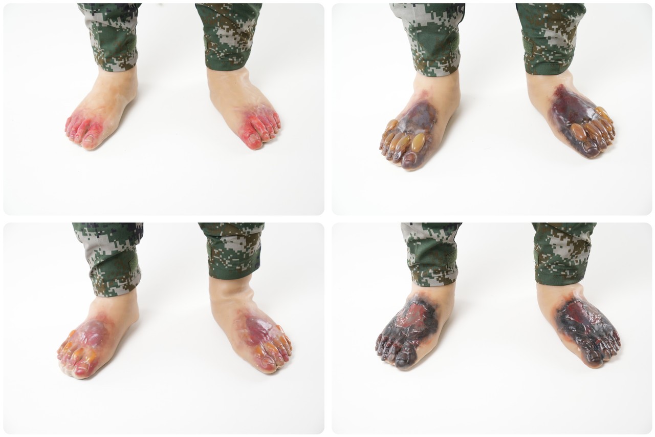 Wearable Frostbite Injury Kit
