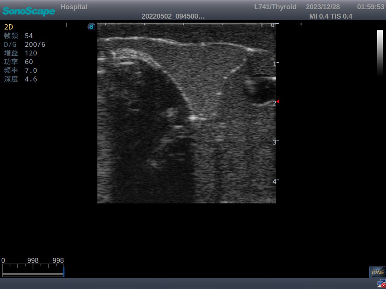 Thyroid Ultrasound Training Model