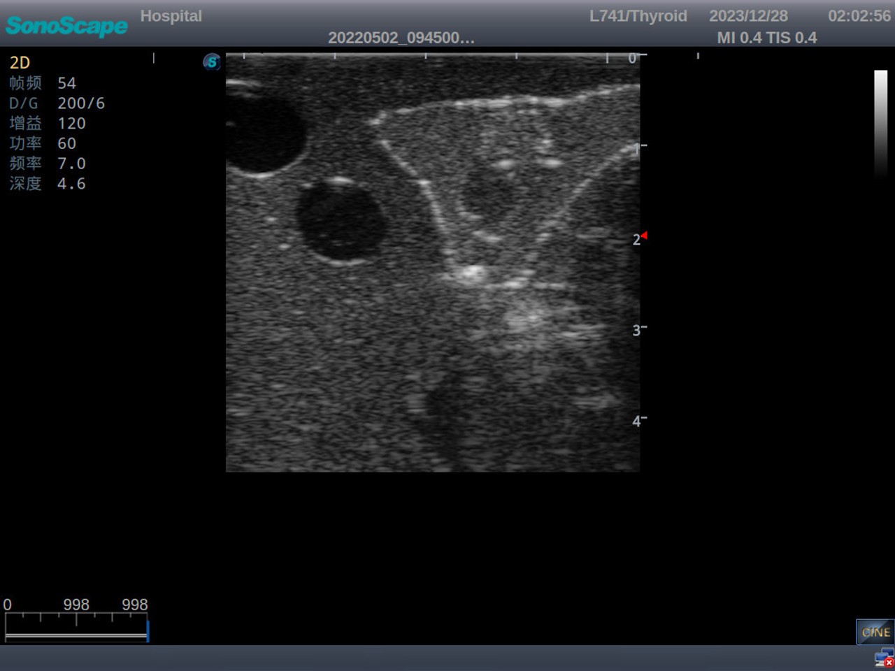 Thyroid Ultrasound Training Model