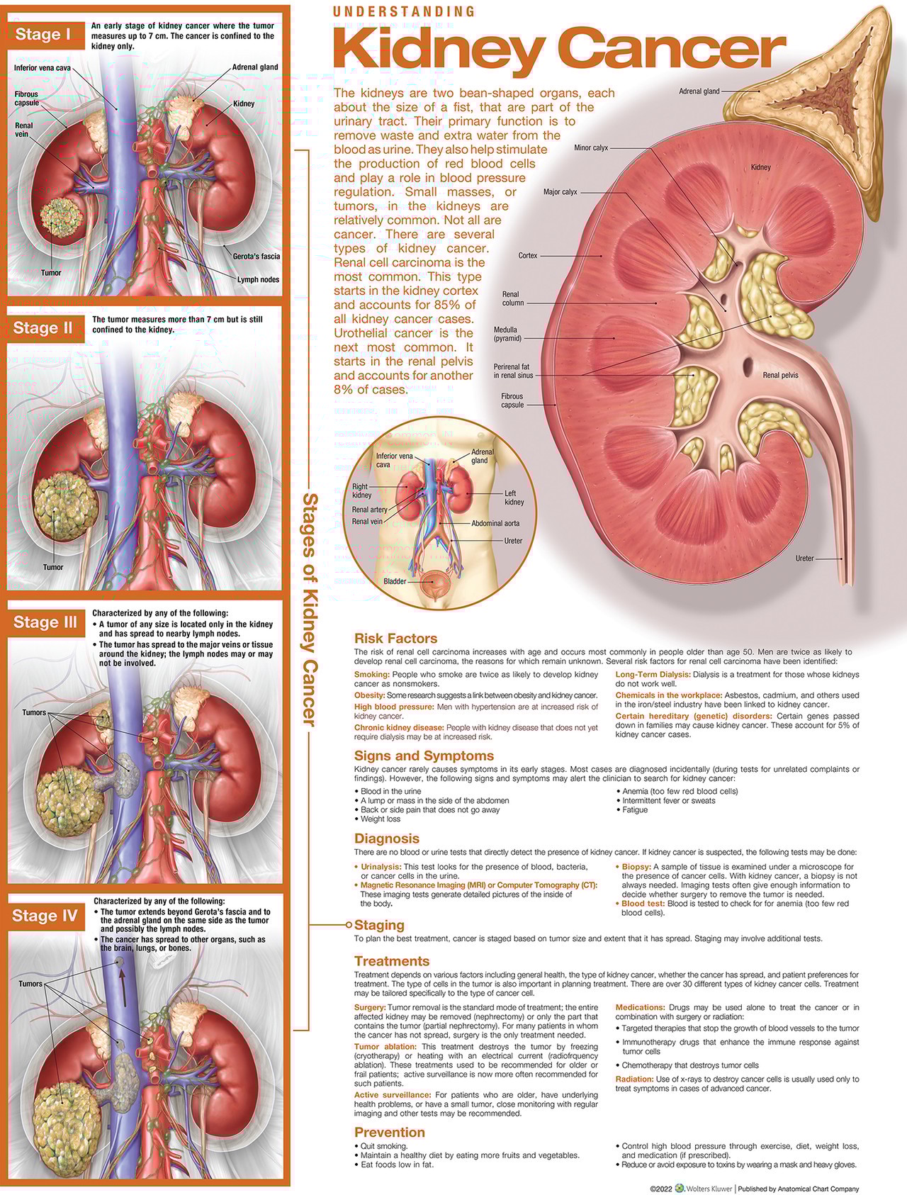 Understanding Kidney Cancer Anatomical Chart, 2nd Edition - Laminated