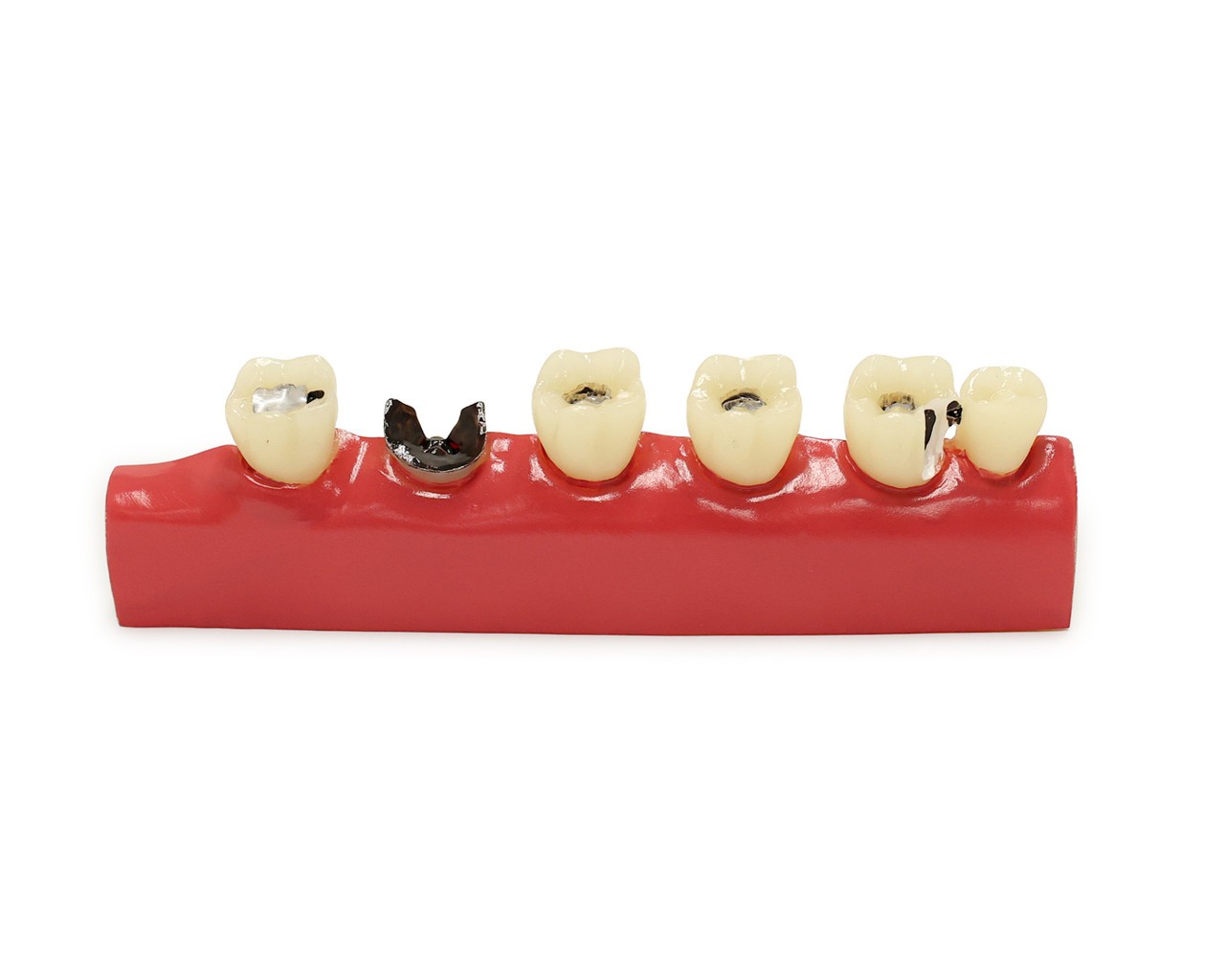 Axis Scientific Stages of Tooth Decay Anatomy Model