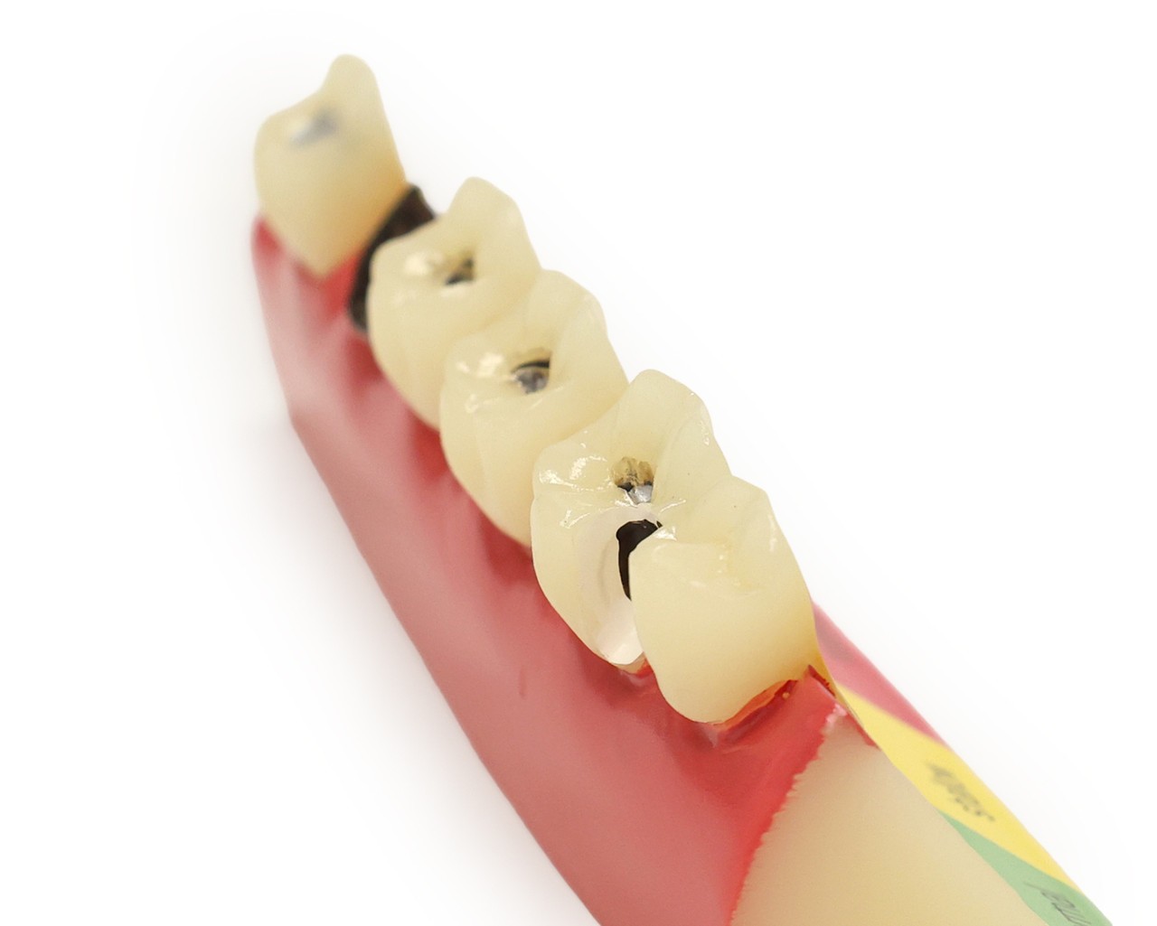 Axis Scientific Stages of Tooth Decay Anatomy Model