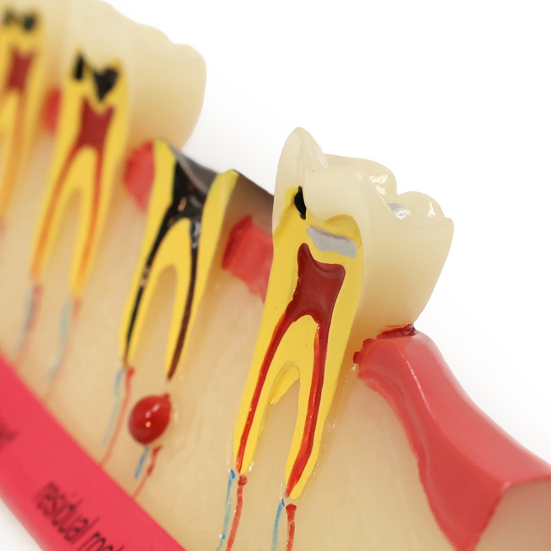 Axis Scientific Stages of Tooth Decay Anatomy Model