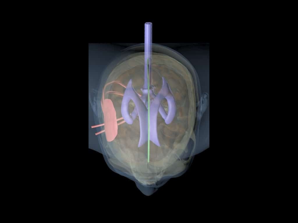 Adult Head (Hematoma) for X-Ray CT, US, MRI