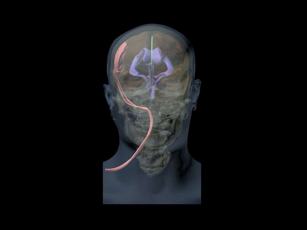 Adult Head (Hematoma) for X-Ray CT, US, MRI