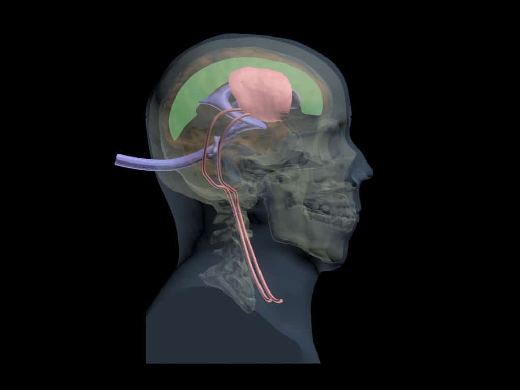 Adult Head (Hematoma) for X-Ray CT, US, MRI