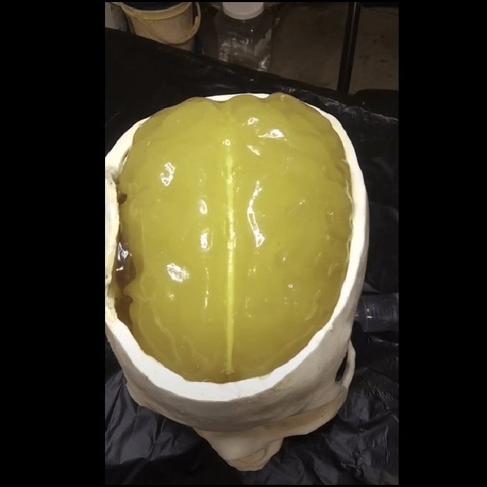 Adult Head (Hematoma) for X-Ray CT, US, MRI