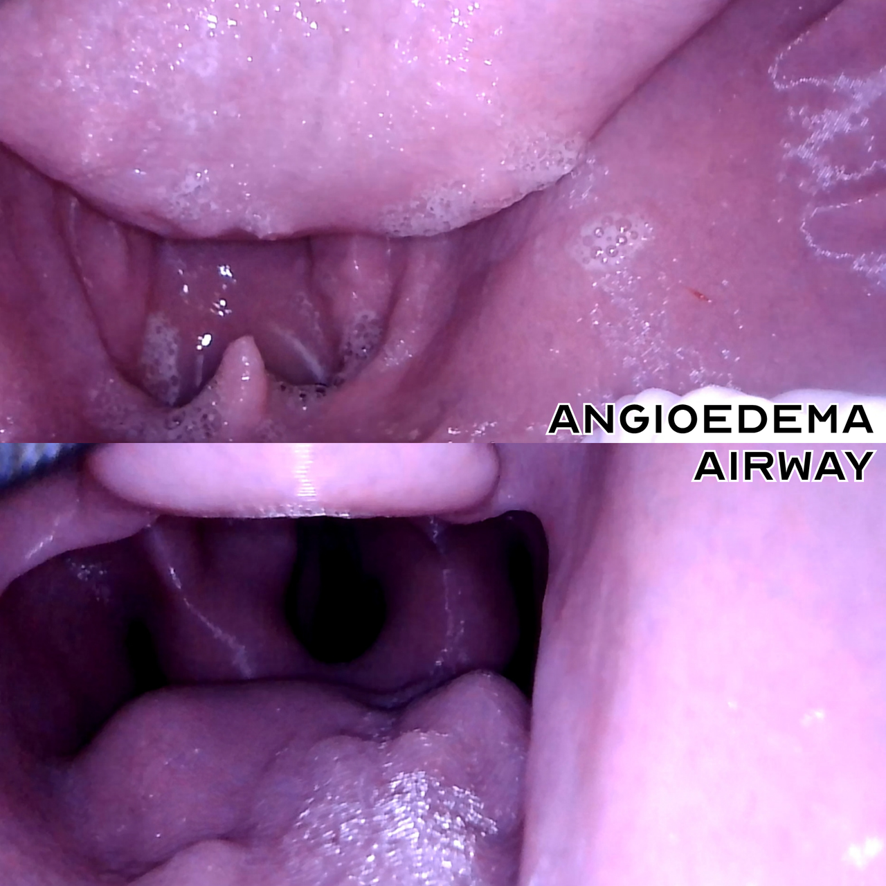 internal view of angioedema airway v2