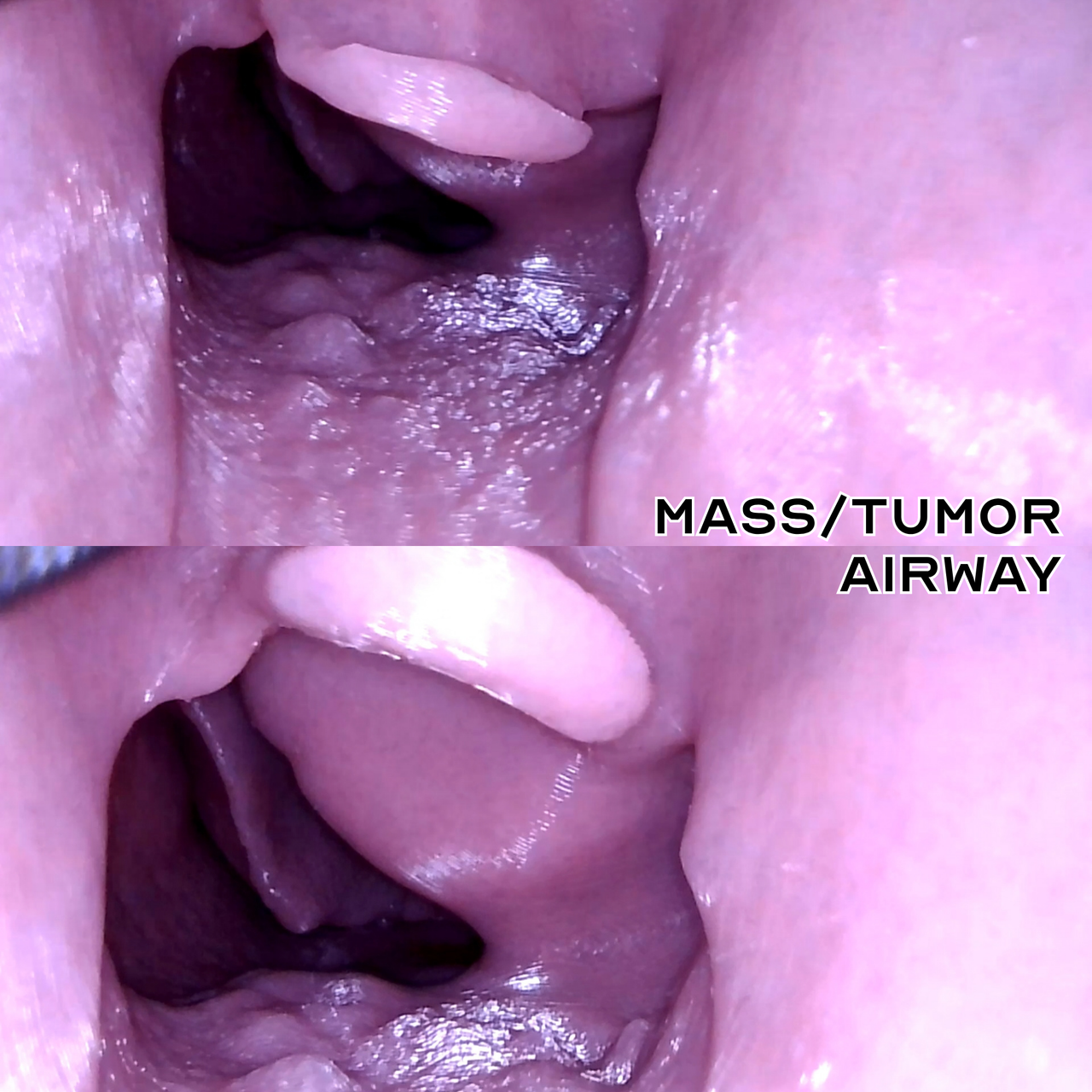 internal view of mass/tumor airway v2