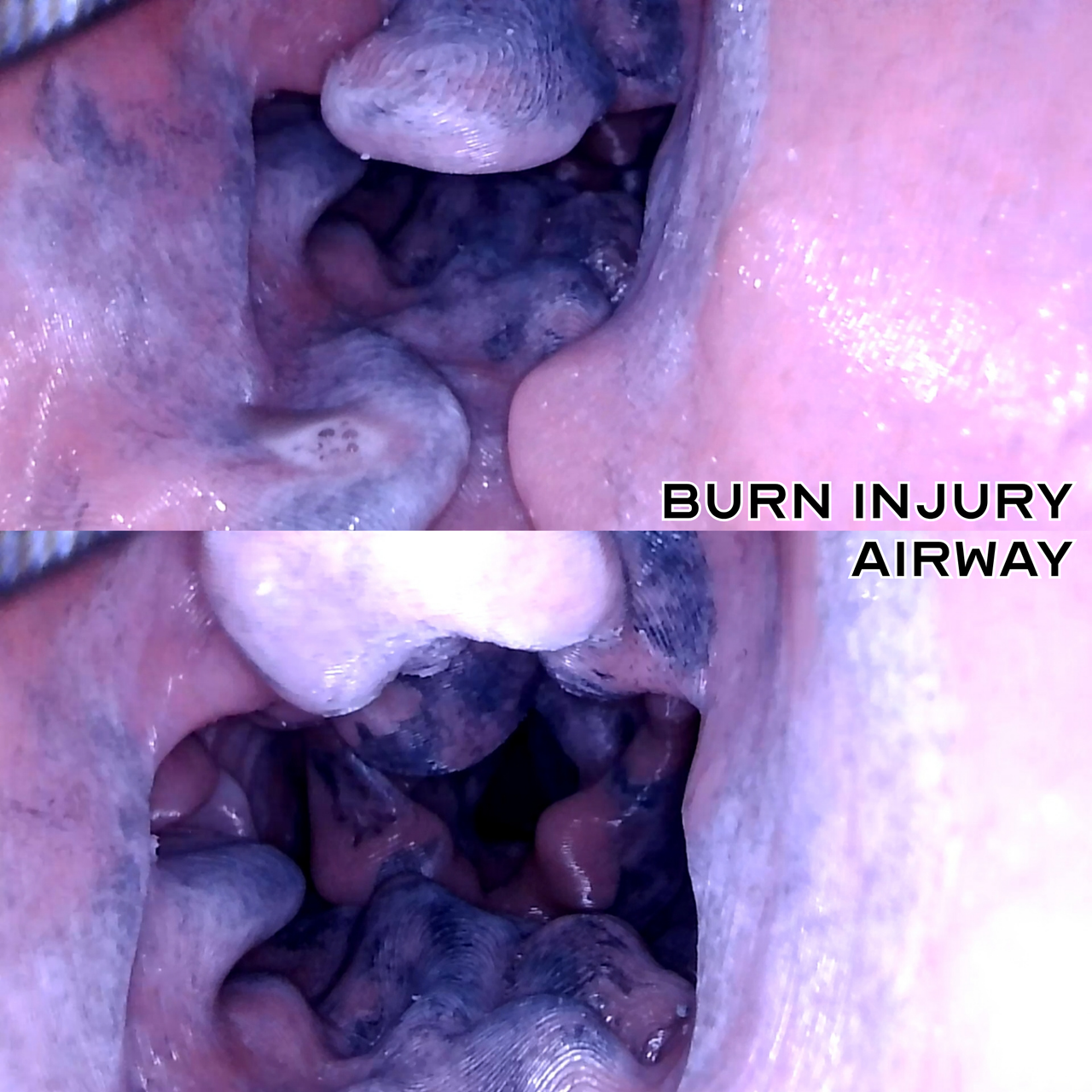 internal view of burn injury airway v2