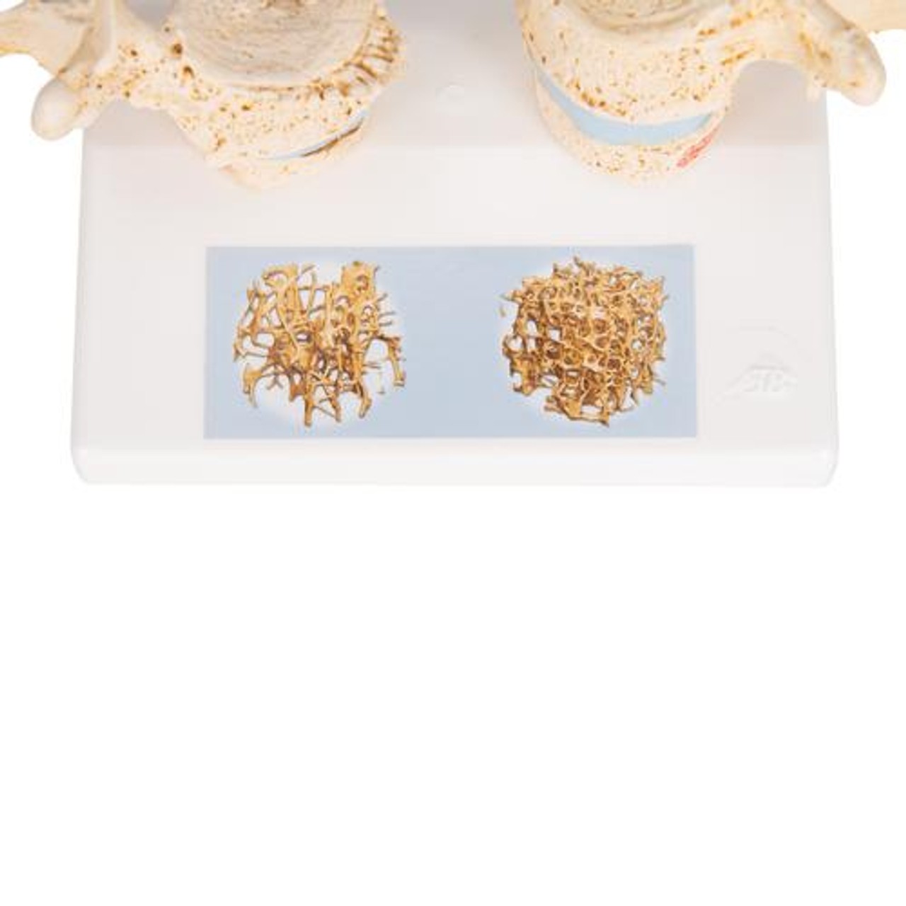 Osteoporosis Anatomy Model