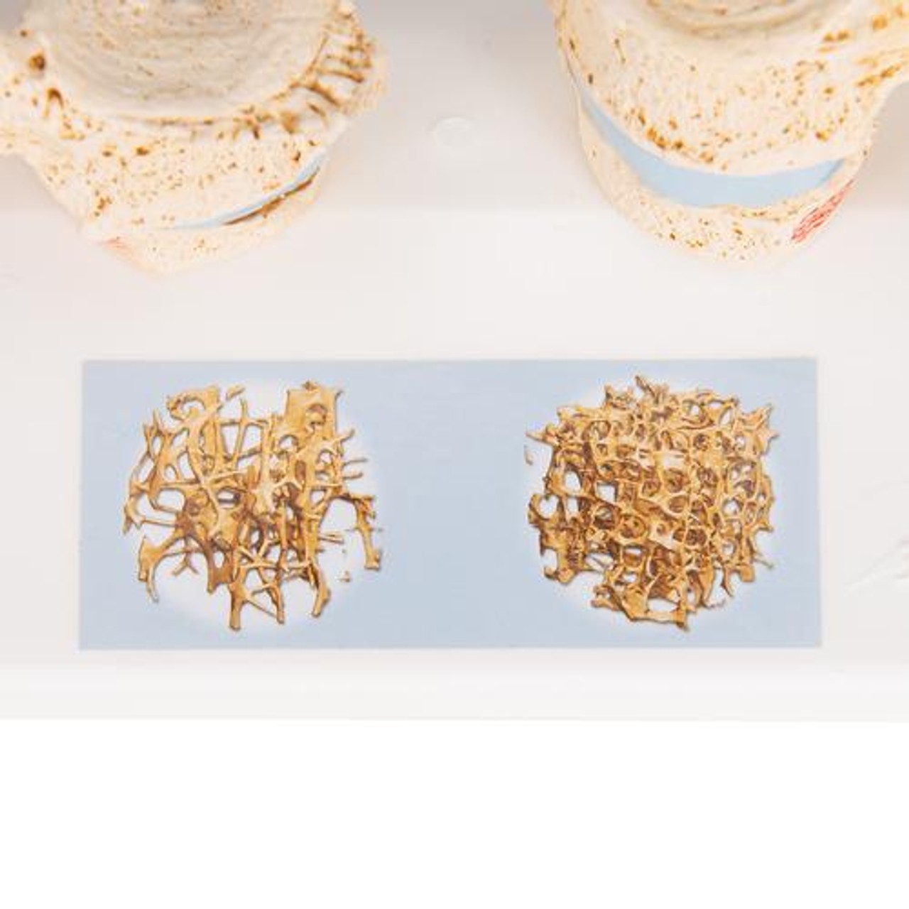 Osteoporosis Anatomy Model