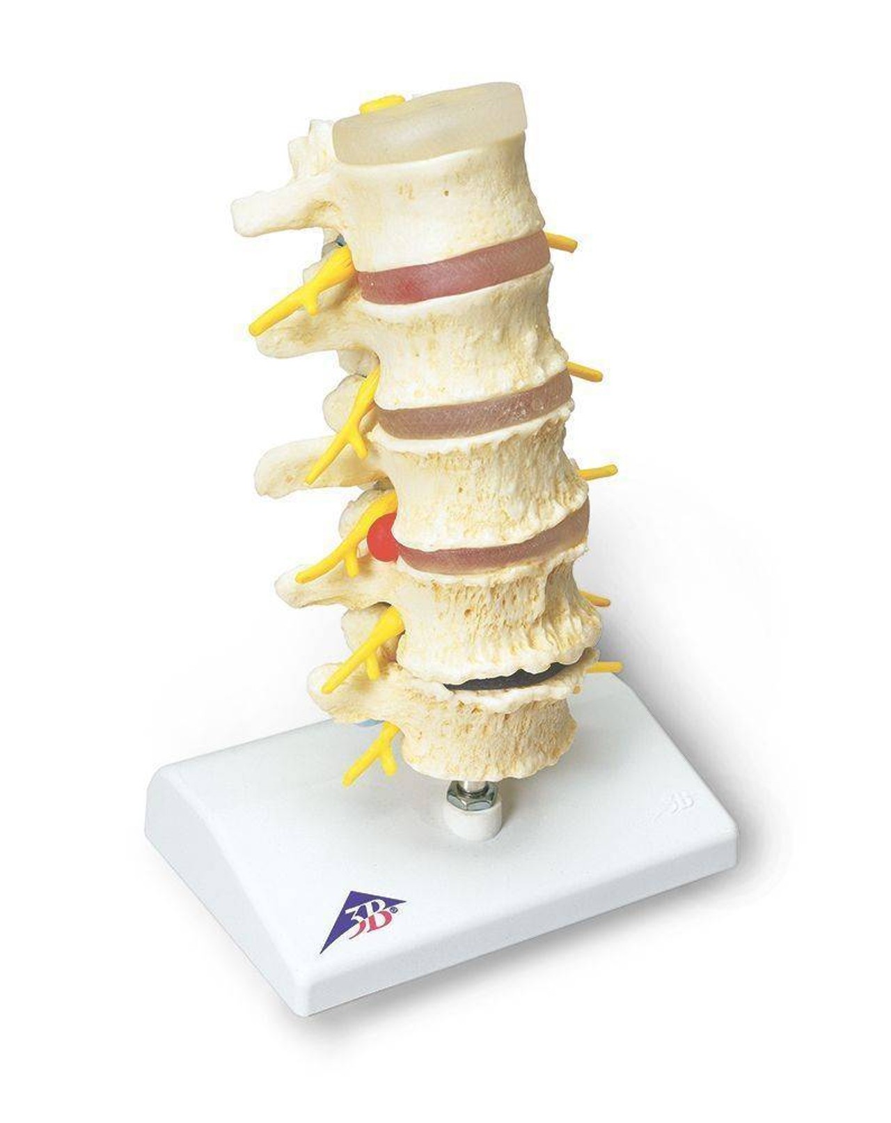 Stages Of Disc Prolapse and Vertebral Degeneration Anatomy Model