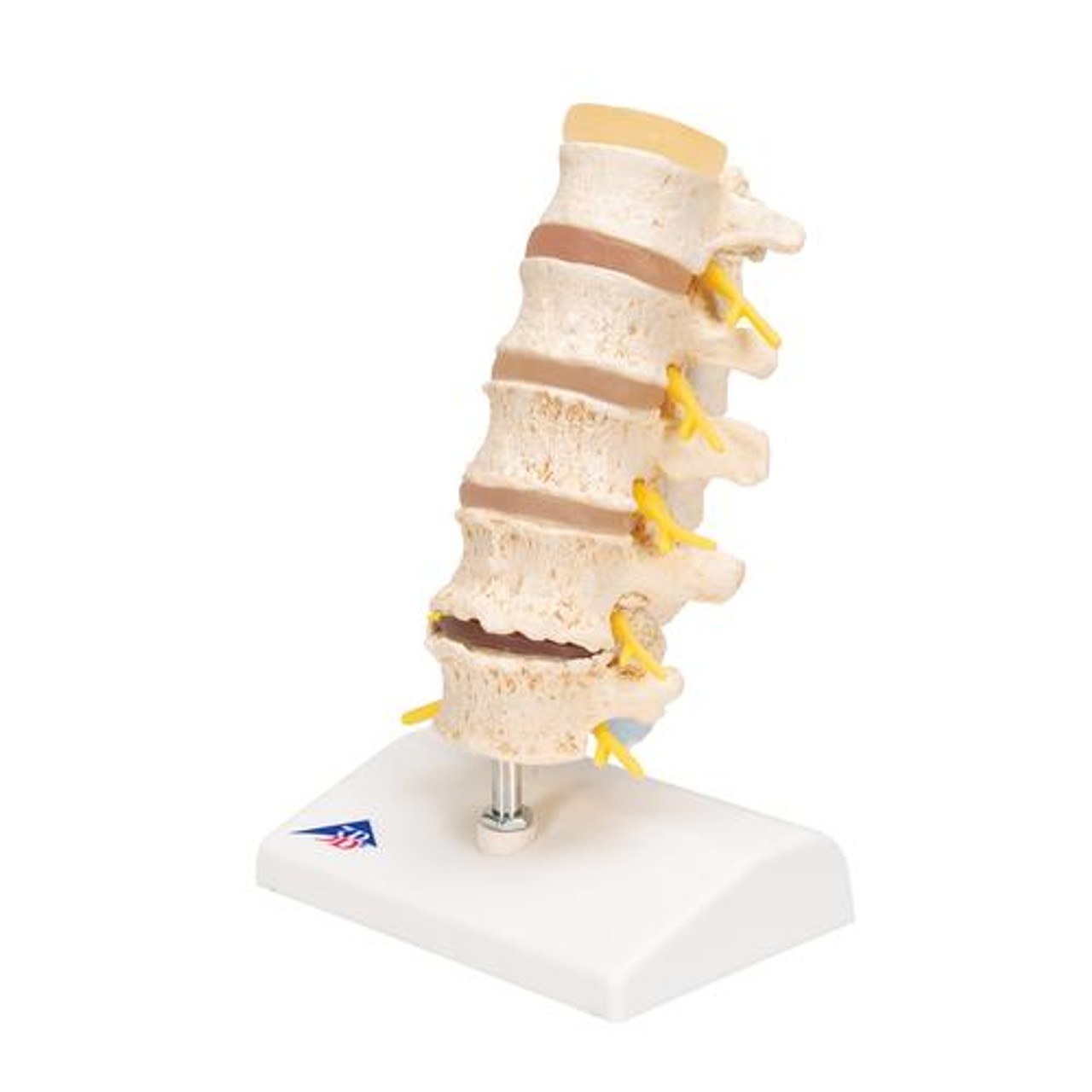 Stages Of Disc Prolapse and Vertebral Degeneration Anatomy Model - Left Side View