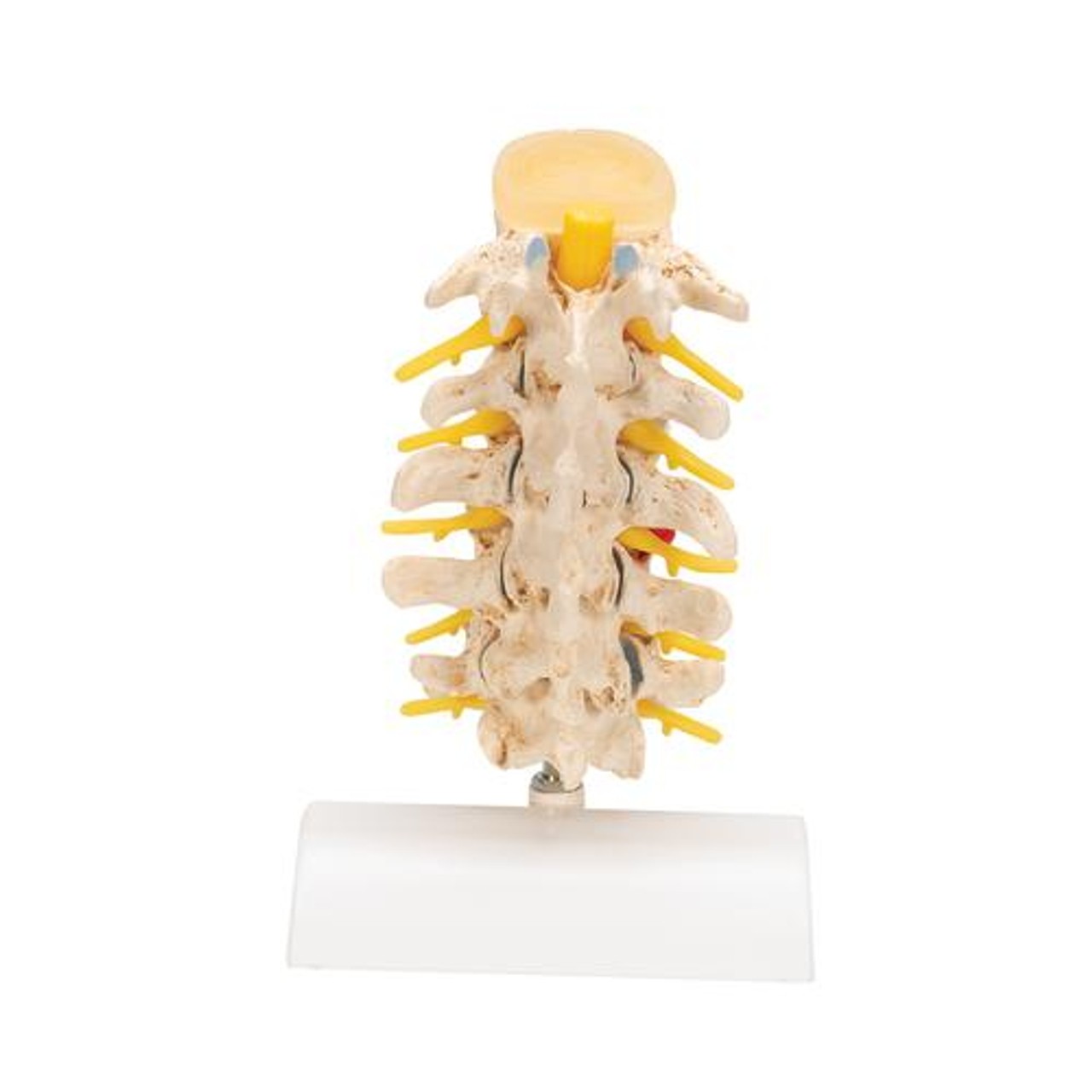 Stages Of Disc Prolapse and Vertebral Degeneration Anatomy Model - Back View