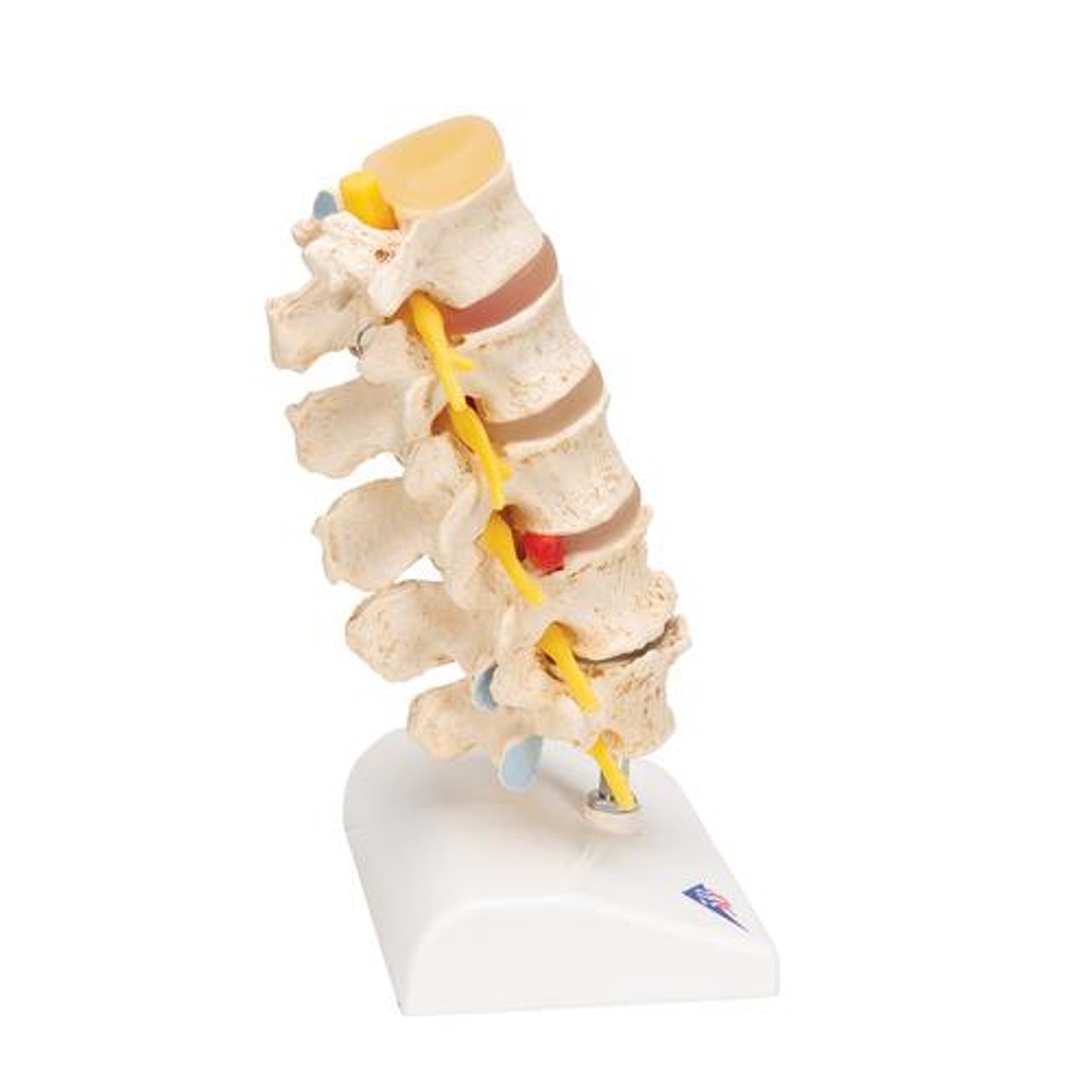 Stages Of Disc Prolapse and Vertebral Degeneration Anatomy Model - Right Side View