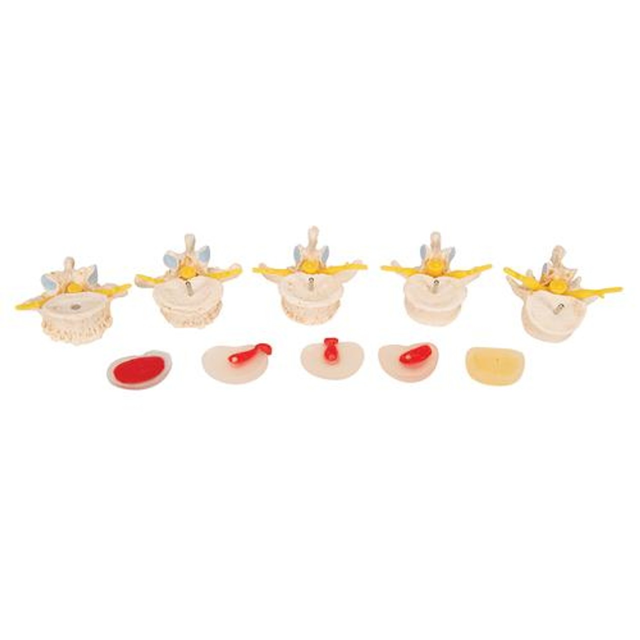 Stages Of Disc Prolapse and Vertebral Degeneration Anatomy Model