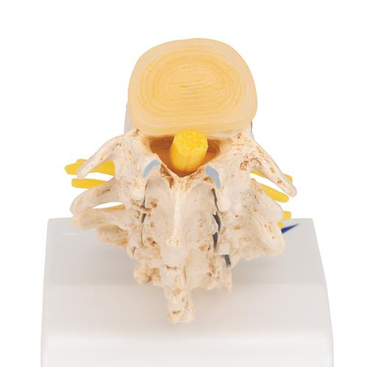 Stages Of Disc Prolapse and Vertebral Degeneration Anatomy Model - Top View