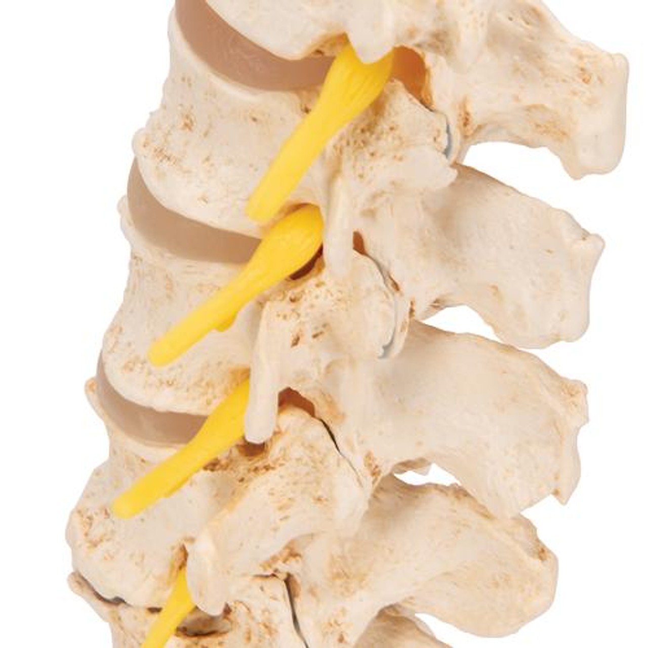 Stages Of Disc Prolapse and Vertebral Degeneration Anatomy Model - Zoom View