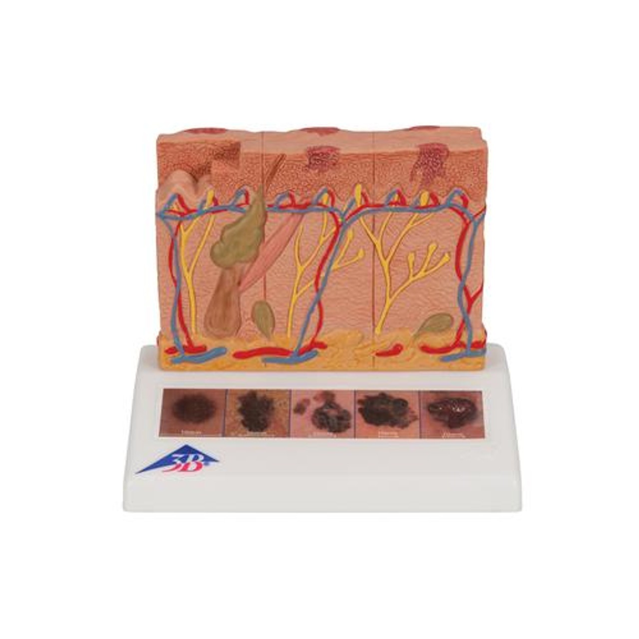 Skin Cancer Stages Model