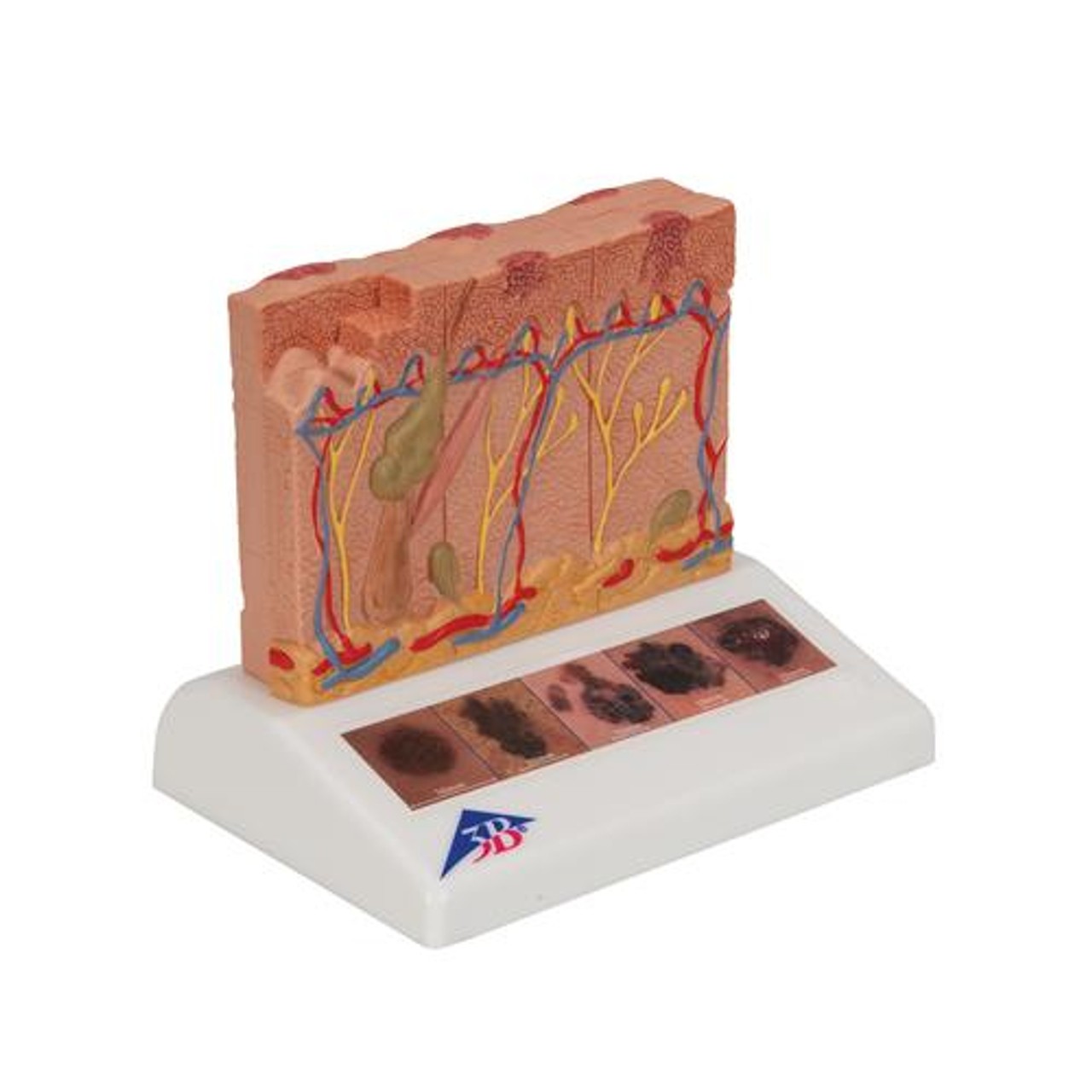 Skin Cancer Stages Model - Right Side View