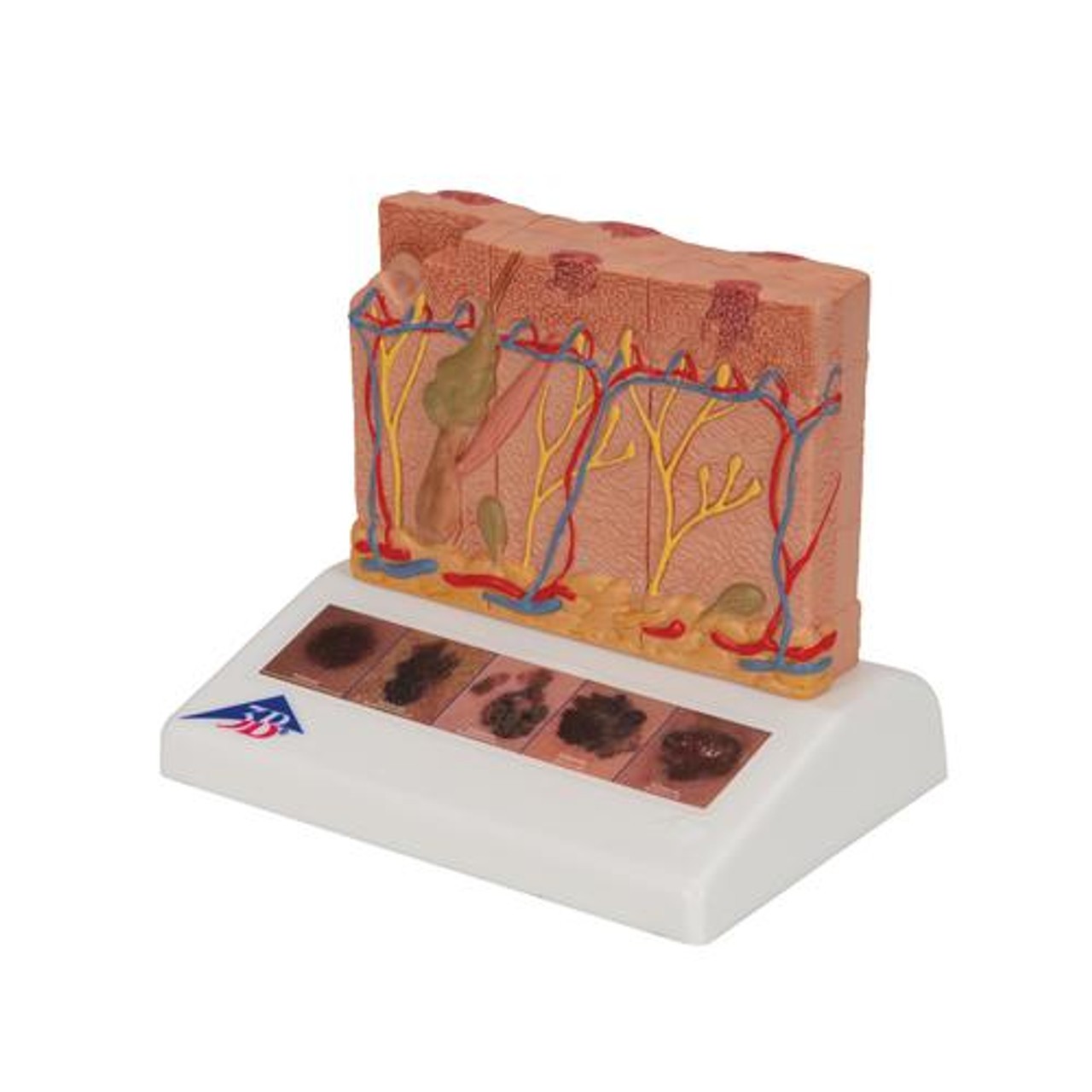 Skin Cancer Stages Model - Left Side View